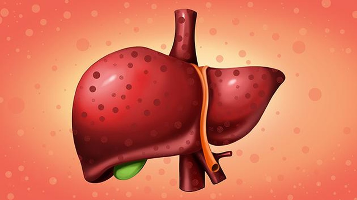 Ilustrasi pengidap hepatitis untuk artikel Kemenkes: 90% Pengidap Hepatitis Tidak Sadar
